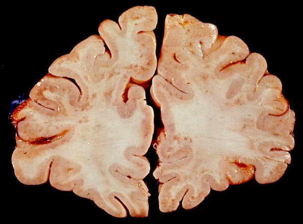 6A PML (Case 6) gross