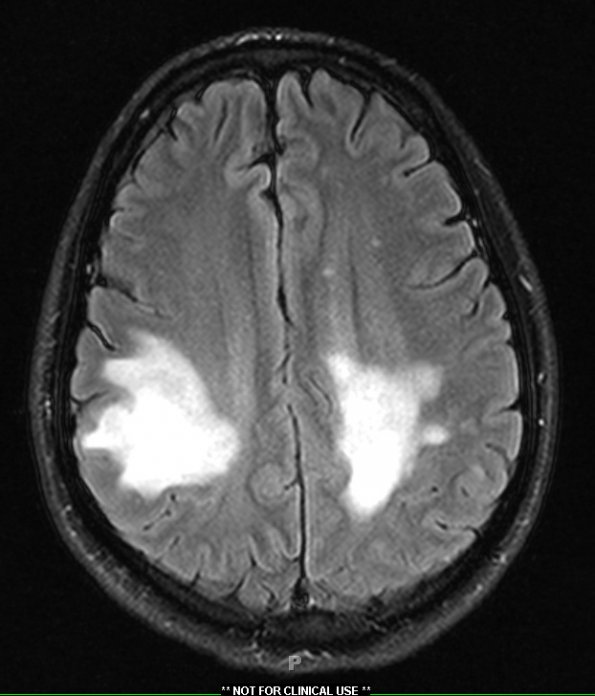 1A1 PML (Case 1) FLAIR slice 8 - Copy