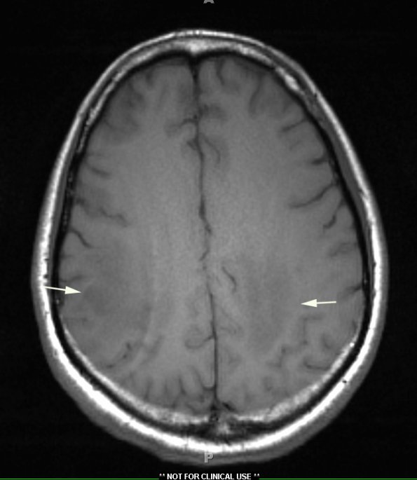 1A2 (Case 1) T1 without contrast slice 8 - Copy copy