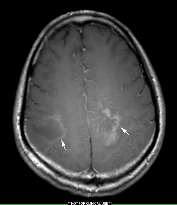 1A3 PML (Case 1) T1 post contrast slice 7 - Copy copy