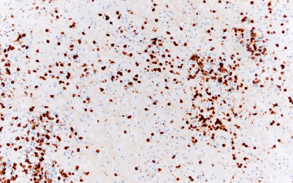 1C9 PML with IRIS (Case 1) CD8 same area 20X A