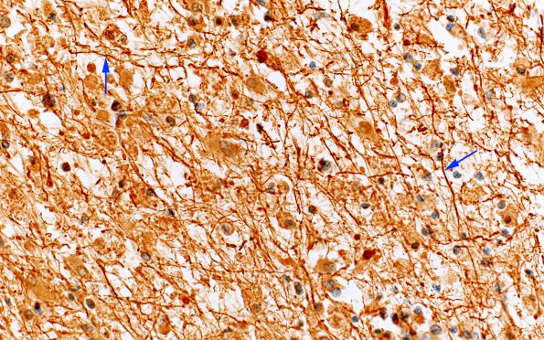 2D4 PML & IRIS (Case 2) NF 20X B copy