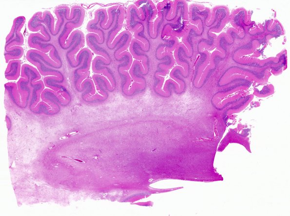 2J1 PML & IRIS (Case 2) cerebellum WM 2