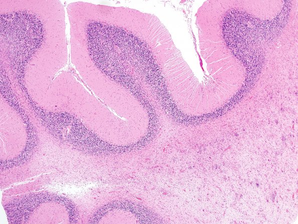 2J2 PML & IRIS (Case 2) cerebellum H&E 1