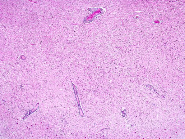 2J3 PML & IRIS (Case 2) cerebellum 1