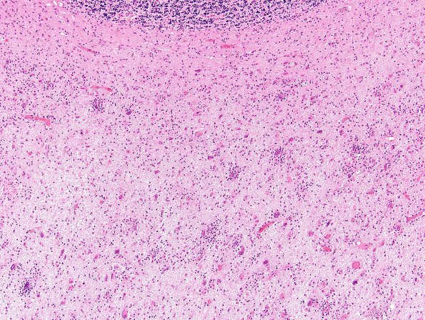 2J4 PML & IRIS (Case 2) cerebellum H&E 4 (2)