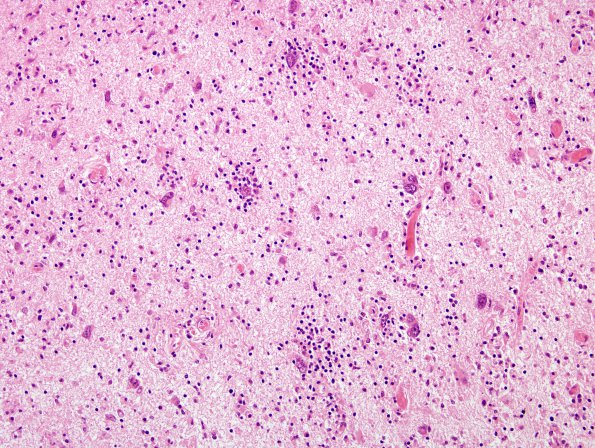 2J5 PML & IRIS (Case 2) cerebellum H&E 2