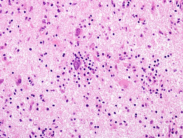 2J6 PML & IRIS (Case 2) cerebellum H&E 3