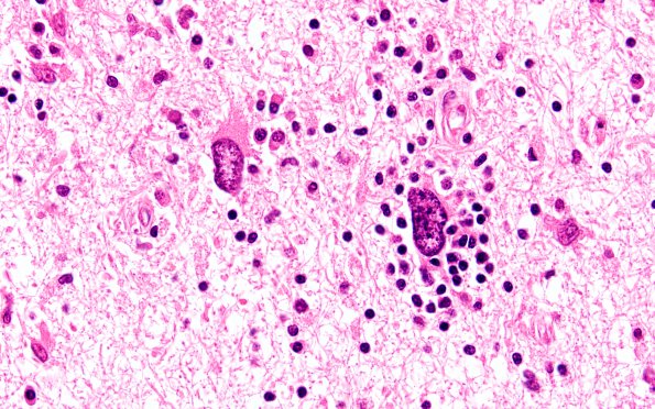 2J7 PML & IRIS (Case 2) cerebellum H&E 3