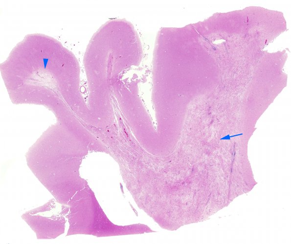 3B1 PML (Case 3) Reconstituted LC H&E whole mount copy