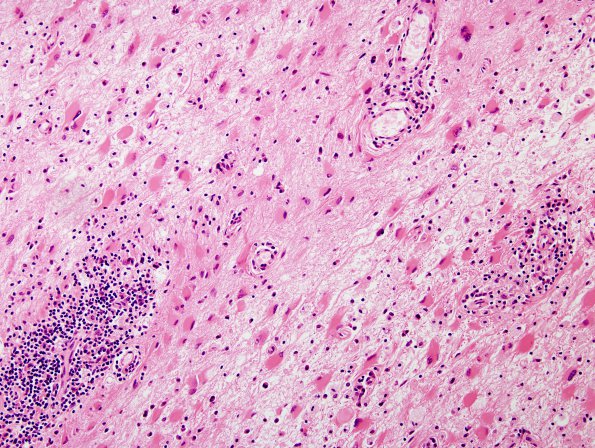 3B5 PML (Case 3) Reconstituted LC H&E 20X 3