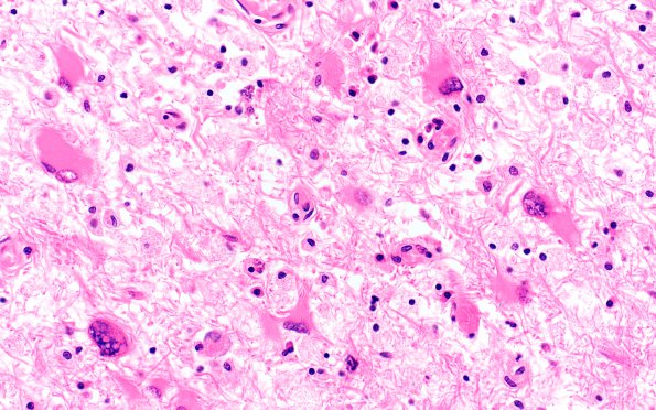 3B6 PML (Case 3) N13 Reconstituted LC H&E 40X