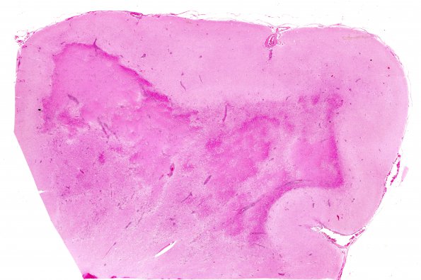 4A1 HIV & PML, Meningoencephalitis, (is IRIS) (AANP 1997 Case 5) H&E whole mount 2