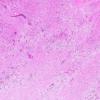 4A2 HIV & PML, Meningoencephalitis, (is IRIS) (AANP 1997 Case 5) H&E 1.5X