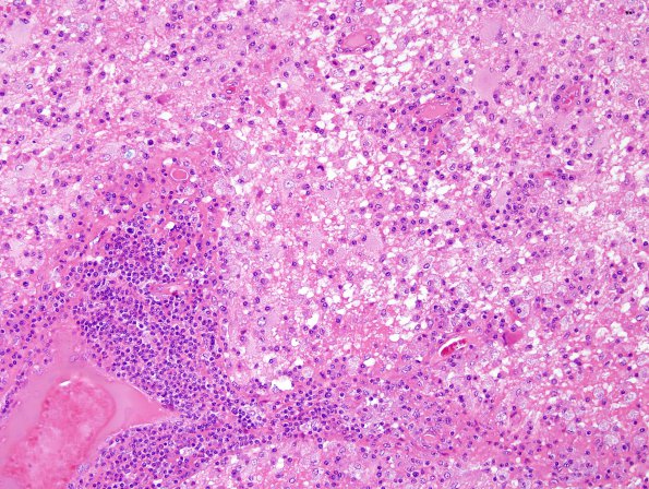 4A3 HIV & PML, Meningoencephalitis, (is IRIS) (AANP 1997 Case 5) H&E 4