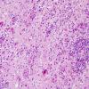 4A4 HIV & PML, Meningoencephalitis, (is IRIS) (AANP 1997 Case 5) H&E 2