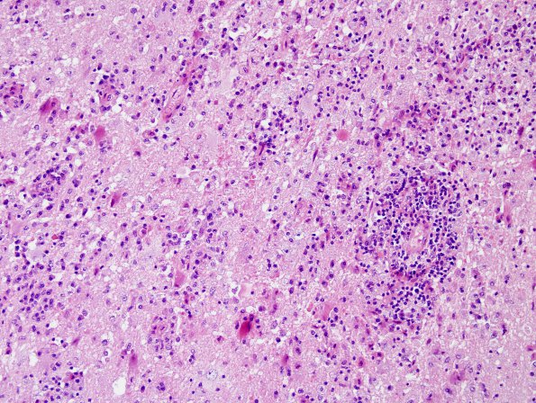 4A4 HIV & PML, Meningoencephalitis, (is IRIS) (AANP 1997 Case 5) H&E 2