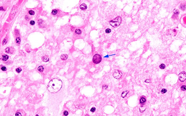 4A6 PML & IRIS cerebellum (Case 2) H&E 100X copy