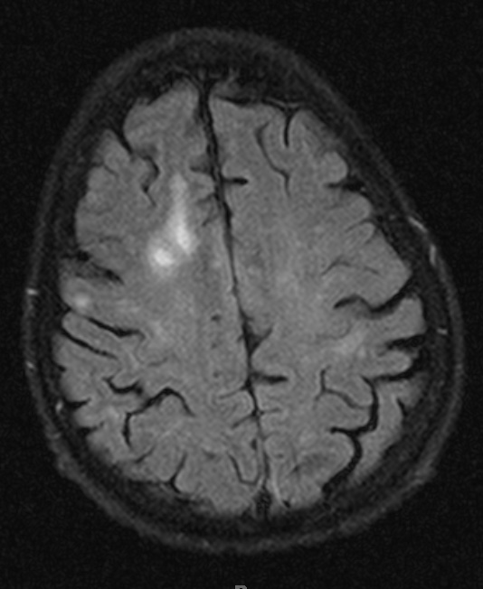 5A1 PML (Case 5) FLAIR 2 - Copy