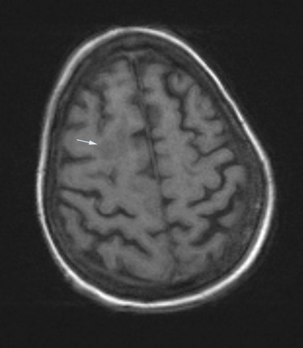 5A2 PML - IRIS (Case 5) T1 no contrast, slice 52 - Copy (2) copy