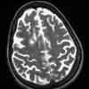 5A4 PML & IRIS (Case 5) T2 with contrast, slice 24 of 90 - Copy