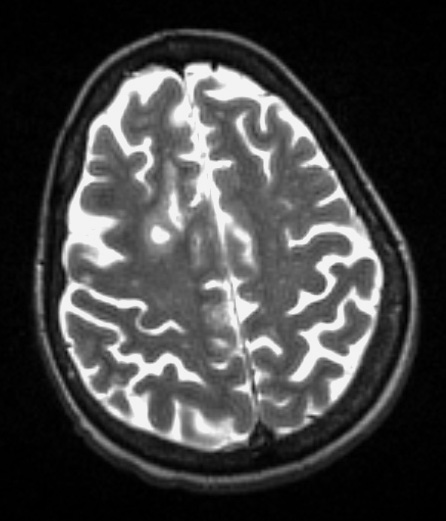 5A4 PML & IRIS (Case 5) T2 with contrast, slice 24 of 90 - Copy