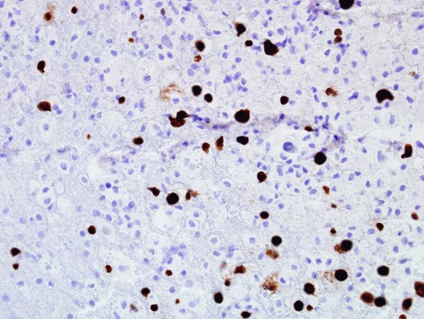 5E2 PML (Case 5) Anti SV40 IHC 4