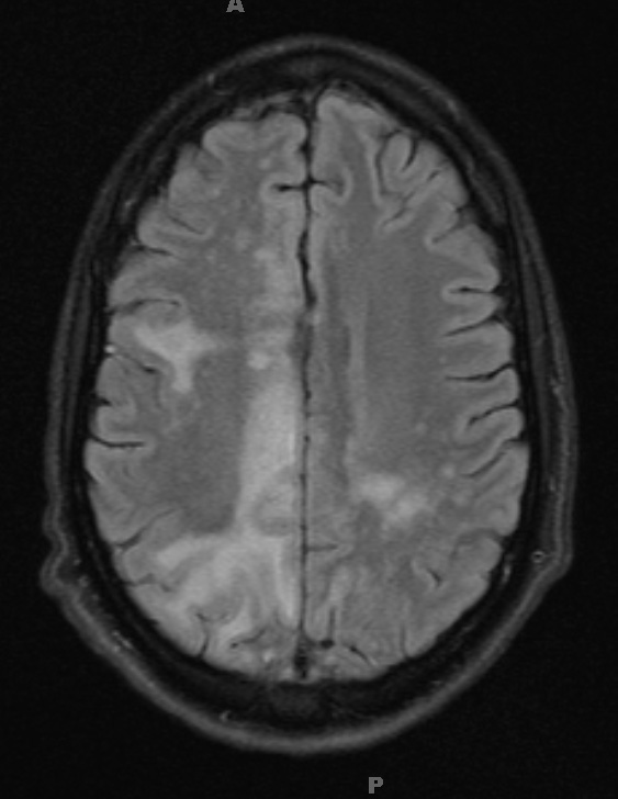 1A1 PML & HIV 1-29 TIRM 1 no contrast (slice 18) - Copy