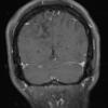 1A3 PML & HIV 1-29 T1 with contrast (slice 23)