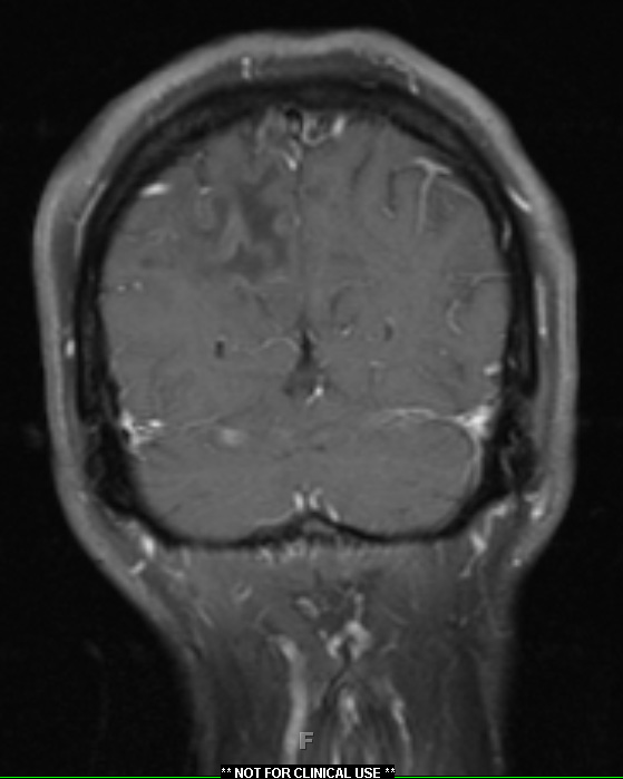 1A3 PML & HIV 1-29 T1 with contrast (slice 23)