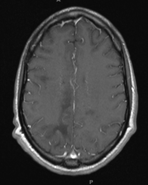 1A4 PML & HIV 1-29 T1 POST contrast slice 18 - Copy - Copy