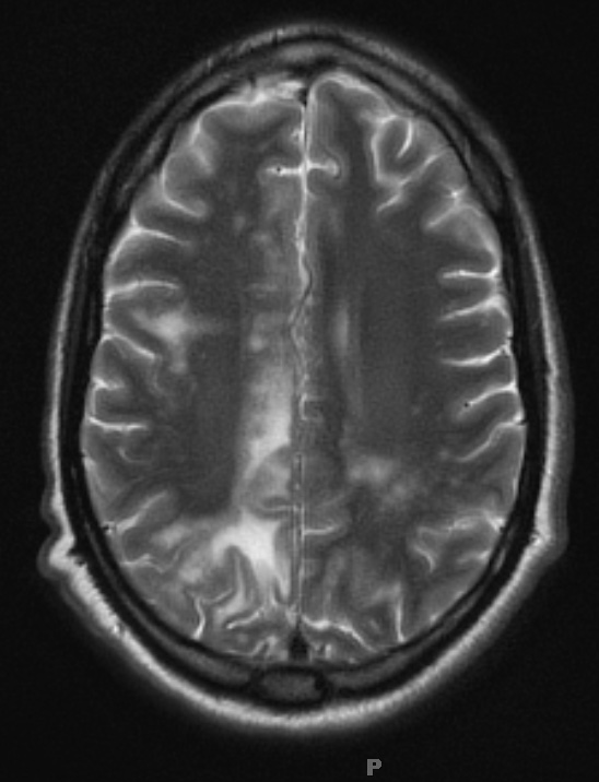 1A5 PML & HIV 1-29 T2 with contrast slice 18 - Copy