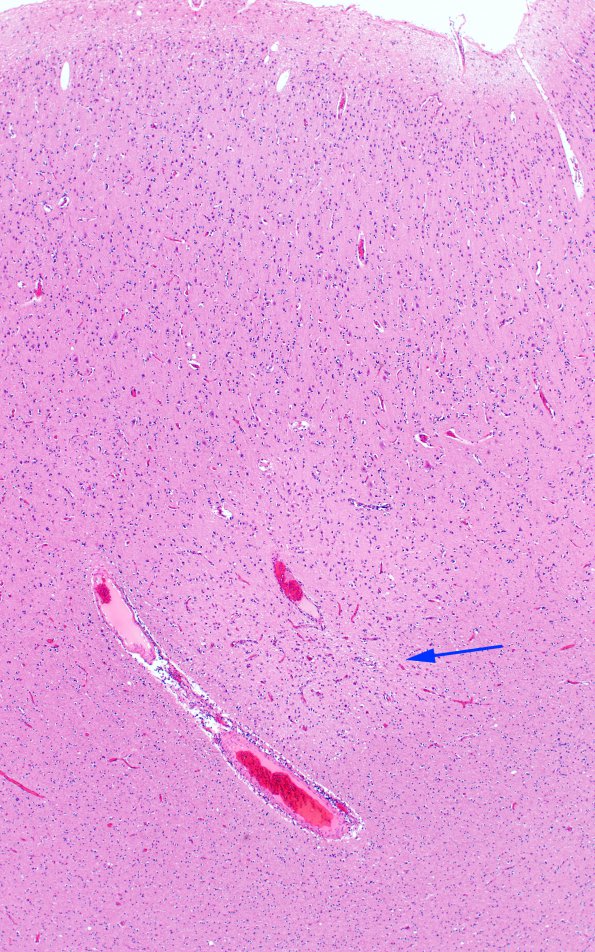 1C5 PML, cortical lesions N11 H&E 9 copy