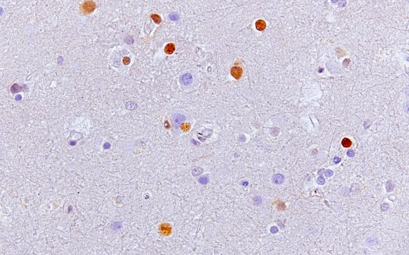 1E1 PML, cortical lesions N11 SV40 10