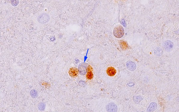 1E2 PML, cortical lesions  N11 SV40 5 copy