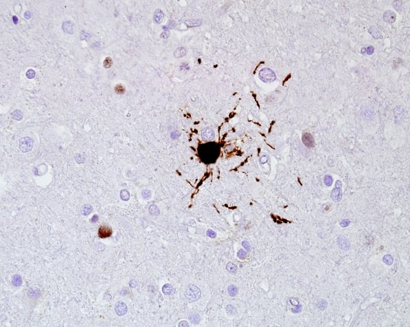 1E3 PML, cortical lesions Anti-SV40 7