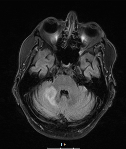 11A1 PML (Case 11) FLAIR 1 - Copy