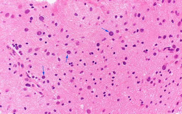 11B3 PML (Case 11) H&E 40X copy A