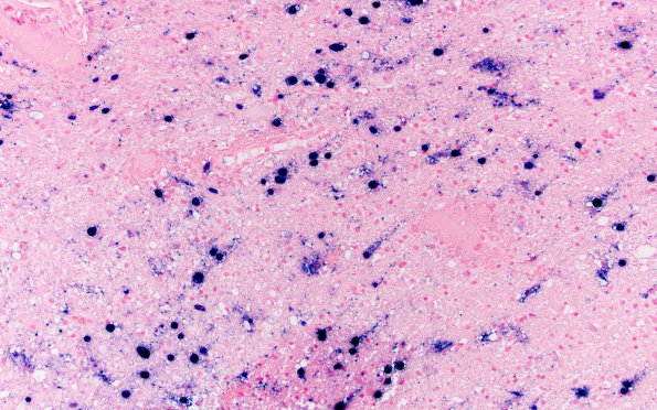 11J1 PML (Case 11) JC ISH 20X