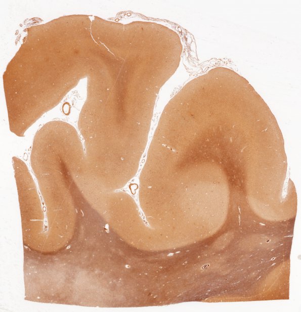 1A3 PML & AD (Case 1) L1 1 Biels whole mount