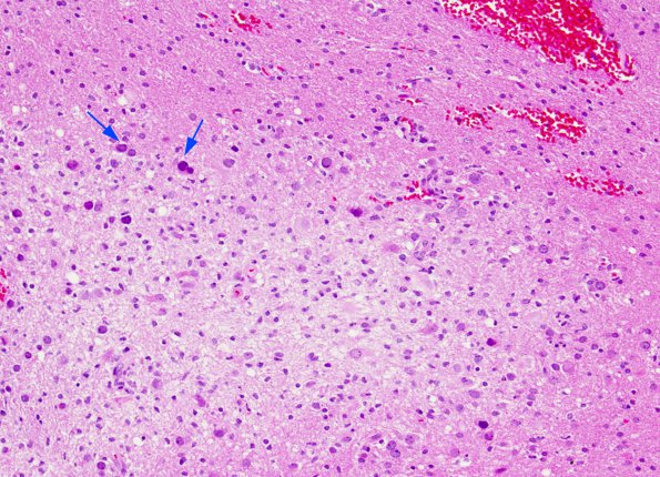 2A2 PML (Case 2) H&E 10X A copy