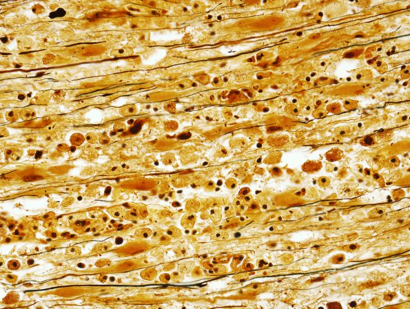 4B3 PML (Case 9) localized, Biels cortex 5