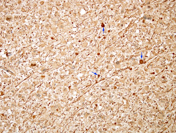 4B4 PML (Case 4) NF 1 copy