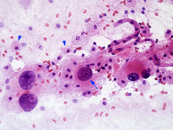 5B2 PML (Case 5) H&E smear 9 copy