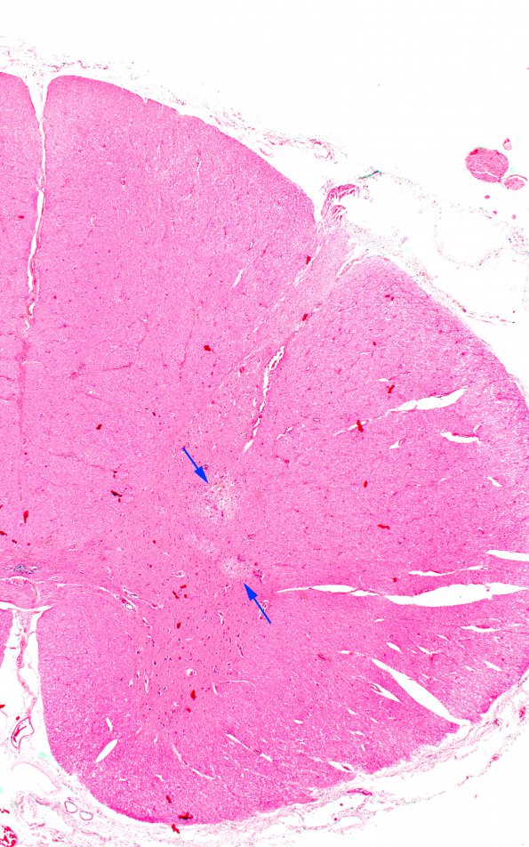 7A1 PML (Case 17) spinal cord 2X A copy