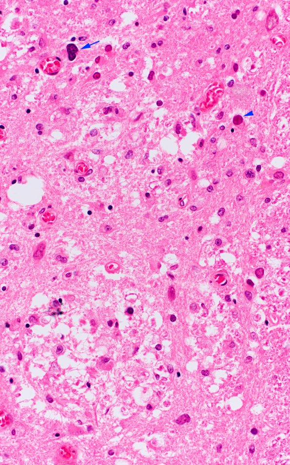 7A3 PML (Case 17) spinal cord 40X A copy