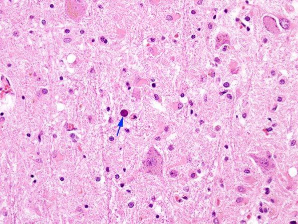 7A4 PML (Case 4) spinal H&E 11 copy