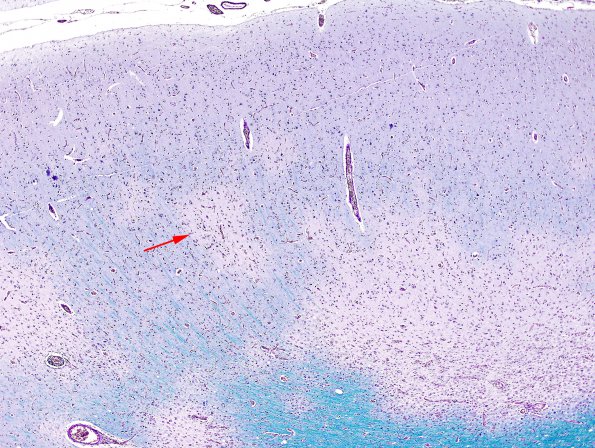 8A1 PML (Case 8) Cortex 2 copy