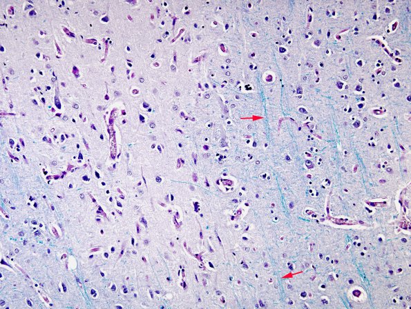 8A2 PML (Case 8) Cortex 1 copy