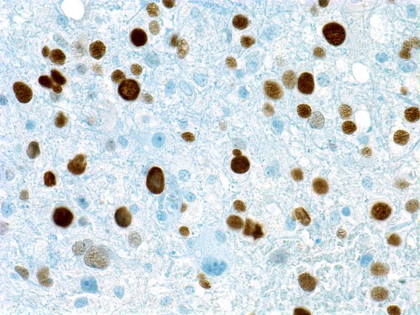 8B5 PML (Case 12) IHC Papova-BK virus large T Ag 2